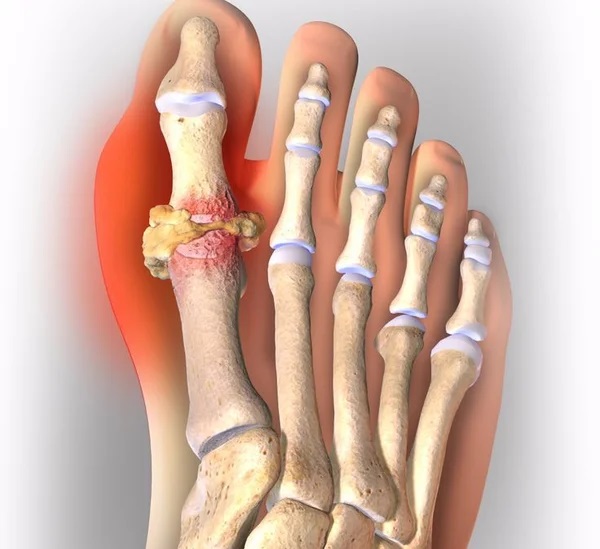 подагра.jpg подагра.jpg